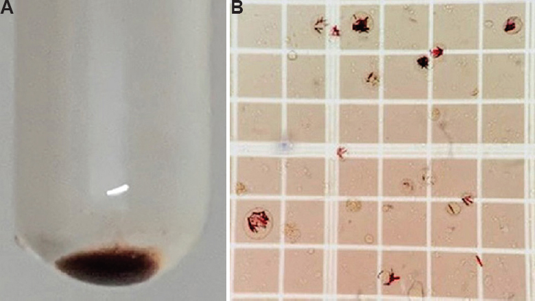 (A) Black sediment with a reddish rim obtained on centrifugation of the bronchoalveolar lavage (BAL) fluid. (B) BAL fluid mounted on a Neubauer hemocytometer showing black-to-red, needle-shaped crystals within alveolar macrophages (unstained BAL fluid, ×100).